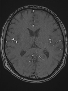 Cerebral arteriovenous malformation (Radiopaedia 84015-99245 Axial TOF 135).jpg