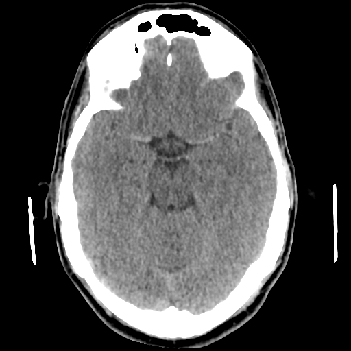 File:Cerebral arteriovenous malformation (Spetzler-Martin grade 2) (Radiopaedia 41262-44076 Axial non-contrast 22).png