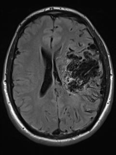 File:Cerebral arteriovenous malformation - huge (Radiopaedia 35734-37272 Axial FLAIR 14).png