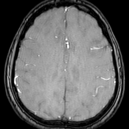 Cerebral arteriovenous malformation at posterior body of corpus callosum (Radiopaedia 74111-84925 Axial MRA 158).jpg