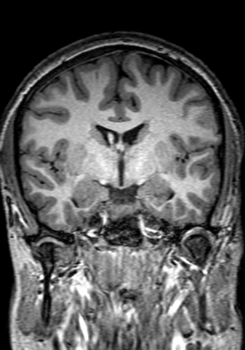 Cerebral arteriovenous malformation at posterior body of corpus callosum (Radiopaedia 74111-84925 Coronal T1 147).jpg