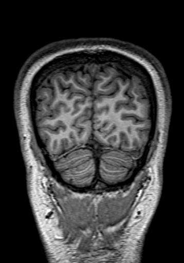 Cerebral arteriovenous malformation at posterior body of corpus callosum (Radiopaedia 74111-84925 Coronal T1 312).jpg
