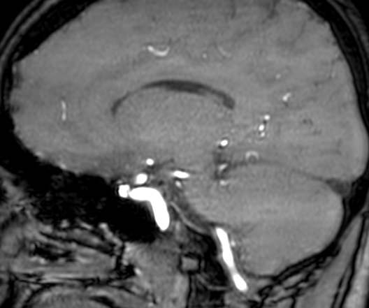 Cerebral arteriovenous malformation at posterior body of corpus callosum (Radiopaedia 74111-84925 J 232).jpg