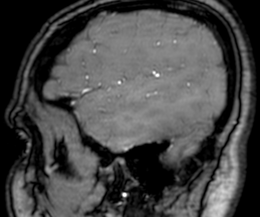 Cerebral arteriovenous malformation at posterior body of corpus callosum (Radiopaedia 74111-84925 J 352).jpg