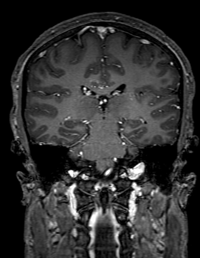 Cerebral arteriovenous malformation at posterior body of corpus callosum (Radiopaedia 74111-84925 K 216).jpg