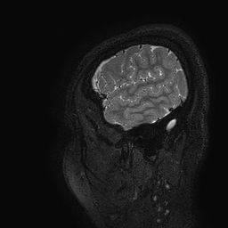 Cerebral arteriovenous malformation at posterior body of corpus callosum (Radiopaedia 74111-84925 Sagittal T2 6).jpg