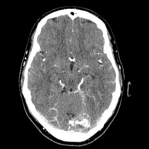 Cerebral arteriovenous malformation with lobar hemorrhage (Radiopaedia 35598-57216 A 24).jpg