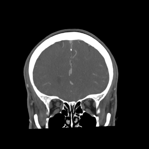 Cerebral arteriovenous malformation with lobar hemorrhage (Radiopaedia 35598-57216 C 26).jpg