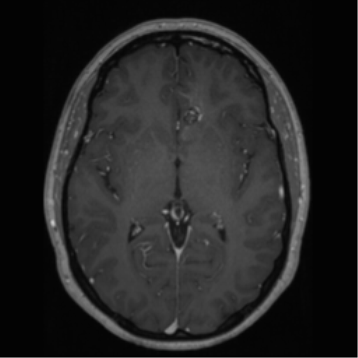 Cerebral cavernoma and development venous anomaly (Radiopaedia 37603-39482 Axial T1 C+ 38).png