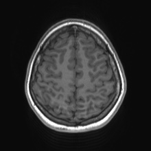 Cerebral cavernous venous malformation (Radiopaedia 70008-80021 Axial T1 70).jpg