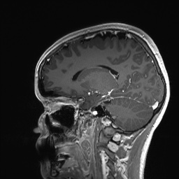Cerebral cavernous venous malformation (Radiopaedia 70008-80021 Sagittal T1 C+ 44).jpg