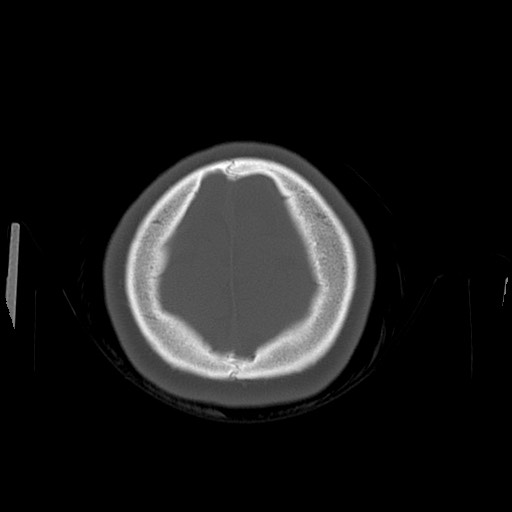 Cerebral cavernous venous malformation (Radiopaedia 70008-80022 Axial bone window 51).jpg