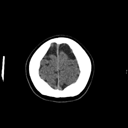 Cerebral cavernous venous malformation (Radiopaedia 70008-80022 Axial non-contrast 50).jpg