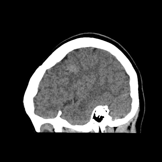 Cerebral cavernous venous malformation (Radiopaedia 70008-80022 C 45).jpg