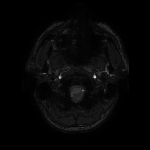 File:Cerebral cavernous venous malformation (Zabramski type II) (Radiopaedia 85511-101198 Axial SWI 10).jpg