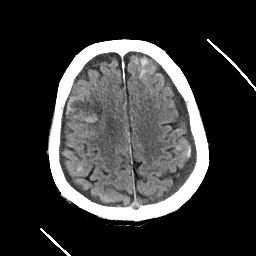 File:Cerebral contusions, subarachnoid hemorrhage and subdural hygromas (Radiopaedia 55399-61829 Axial non-contrast 11).png