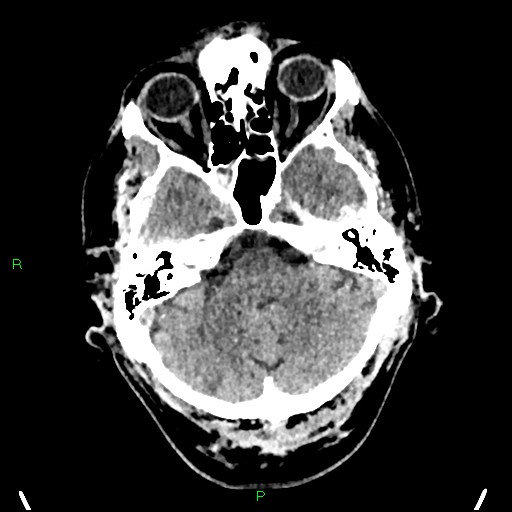 Cerebral contusions (Radiopaedia 33868-35039 Axial non-contrast 46).jpg