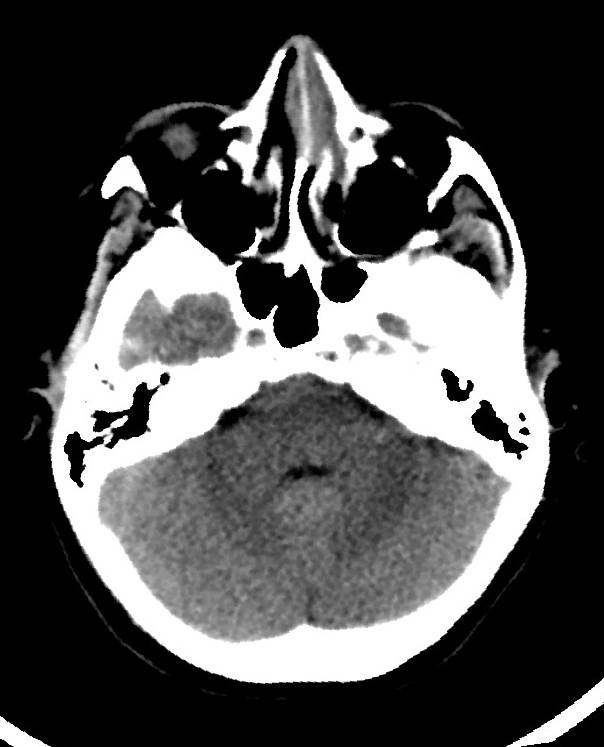 Cerebral edema due to severe hyponatremia (Radiopaedia 89826-106938 Axial non-contrast 28).jpg