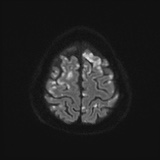 Cerebral embolic infarcts (embolic shower) (Radiopaedia 72391-82921 Axial DWI 56).jpg