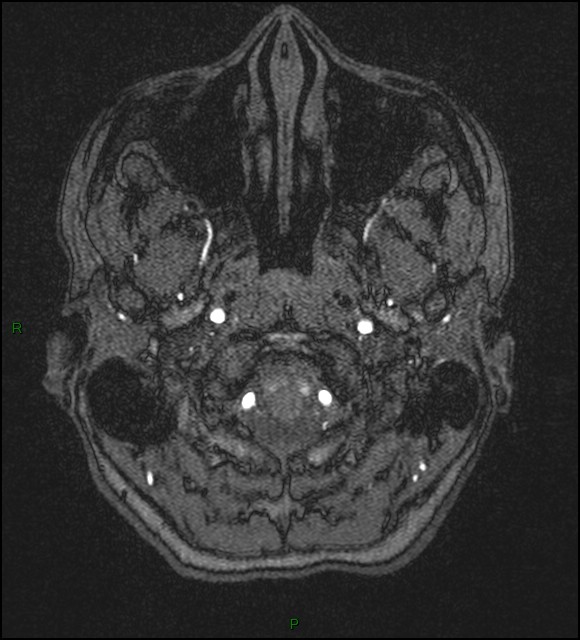 Cerebral fat embolism (Radiopaedia 35022-36525 Axial TOF 1).jpg
