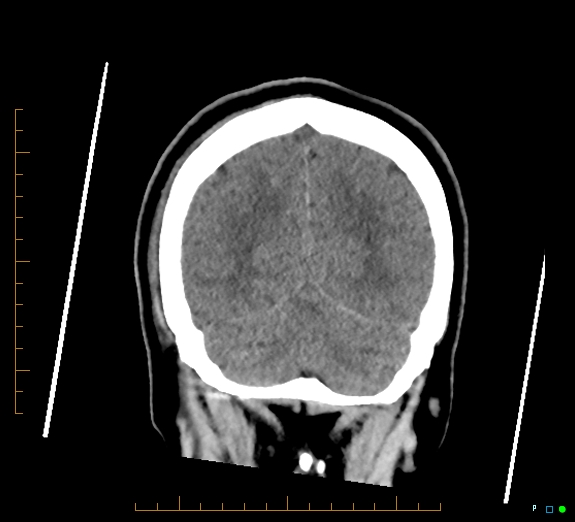 Cerebral fat embolism (Radiopaedia 85521-101220 Coronal non-contrast 50).jpg