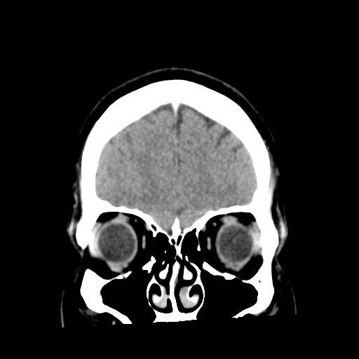 Cerebral hemorrhage secondary to arteriovenous malformation (Radiopaedia 33497-34561 C 12).png