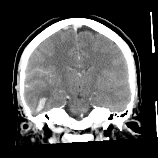 Cerebral hemorrhage secondary to arteriovenous malformation (Radiopaedia 33497-34561 C 35).png