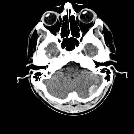File:Cerebral hemorrhagic contusions- temporal evolution (Radiopaedia 40224-42753 Axial non-contrast 6).png