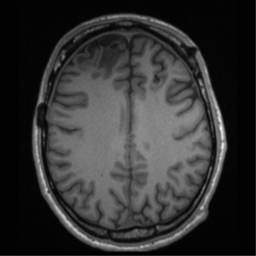 File:Cerebral hemorrhagic contusions- temporal evolution (Radiopaedia 40224-42757 Axial T1 53).png