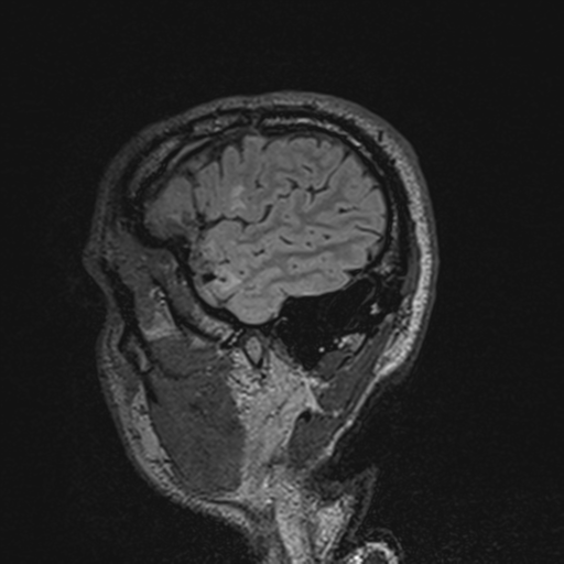 File:Cerebral hemorrhagic contusions- temporal evolution (Radiopaedia 40224-42757 Sagittal T1 69).png