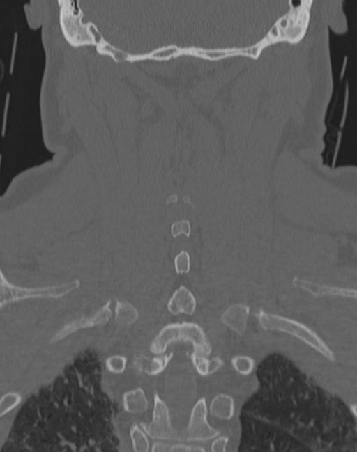 Cerebral hemorrhagic contusions and cervical spine fractures (Radiopaedia 32865-33841 Coronal bone window 56).jpg
