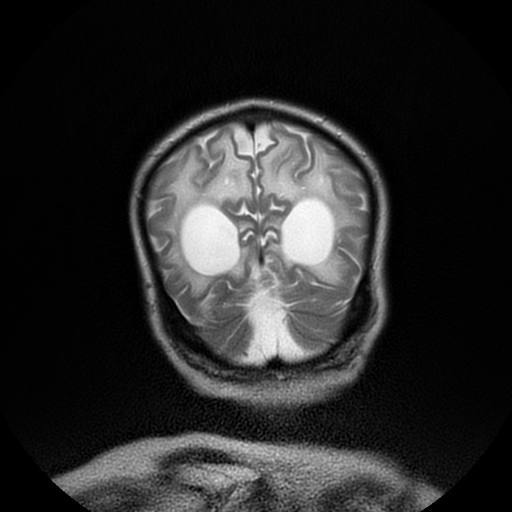 File:Cerebral manifestations of mucopolysaccharidosis type I (Radiopaedia 59171-66487 Coronal T2 19).jpg