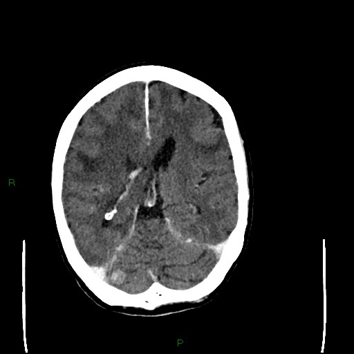 Cerebral metastases - breast primary (Radiopaedia 77653-89857 Axial C+ delayed 66).jpg