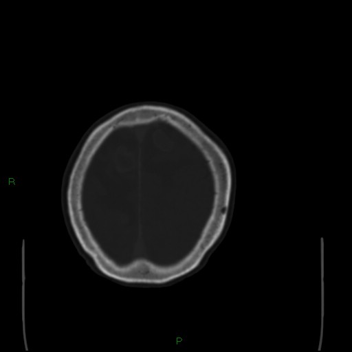 Cerebral metastases - breast primary (Radiopaedia 77653-89857 Axial bone window 100).jpg