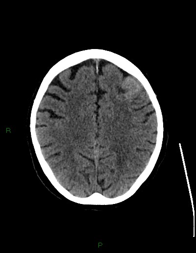 Cerebral metastases - ependymal and parenchymal (Radiopaedia 79877-93131 Axial non-contrast 54).jpg