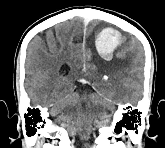 Cerebral metastases - testicular choriocarcinoma (Radiopaedia 84486-99855 D 41).jpg
