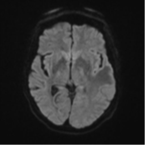 Cerebral metastasis (Radiopaedia 46744-51248 Axial DWI 41).png