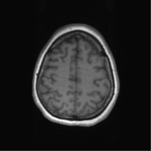 Cerebral metastasis mimicking glioblastoma (Radiopaedia 69155-78937 Axial T1 54).png