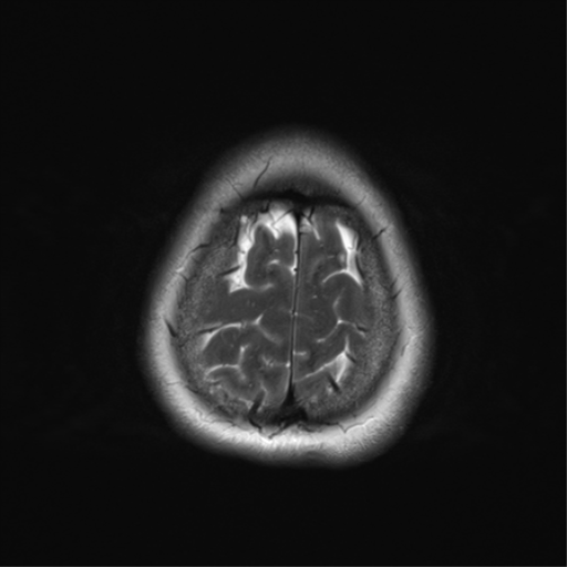 File:Cerebral metastasis mimicking glioblastoma (Radiopaedia 69155-78937 Axial T2 37).png
