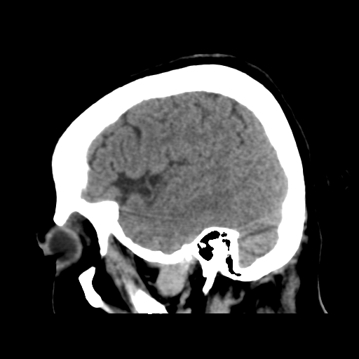 File:Cerebral metastasis to basal ganglia (Radiopaedia 81568-95412 E 47).png