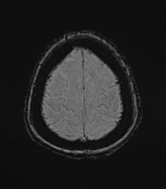 Cerebral metastasis to basal ganglia (Radiopaedia 81568-95413 Axial SWI 76).png