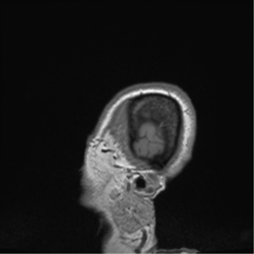 Cerebral metastasis to basal ganglia (Radiopaedia 81568-95413 Sagittal T1 75).png