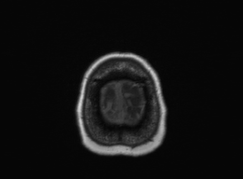 Cerebral ring enhancing lesions - cerebral metastases (Radiopaedia 44922-48817 Axial T1 104).jpg