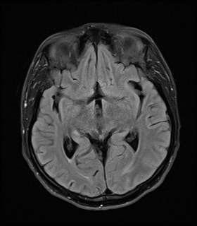 File:Cerebral toxoplasmosis (Radiopaedia 43956-47461 Axial FLAIR 10).jpg