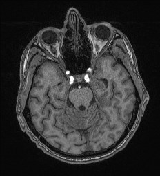 Cerebral toxoplasmosis (Radiopaedia 43956-47461 Axial T1 25).jpg
