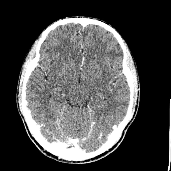 Cerebral toxoplasmosis (Radiopaedia 53993-60131 Axial C+ delayed 31).jpg