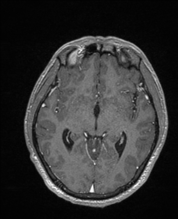 Cerebral toxoplasmosis (Radiopaedia 85779-101597 Axial T1 C+ 76).jpg
