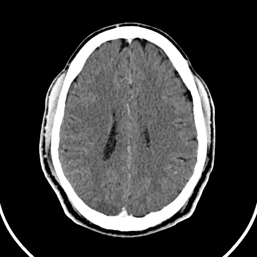 File:Cerebral venous angioma (Radiopaedia 69959-79977 B 64).jpg