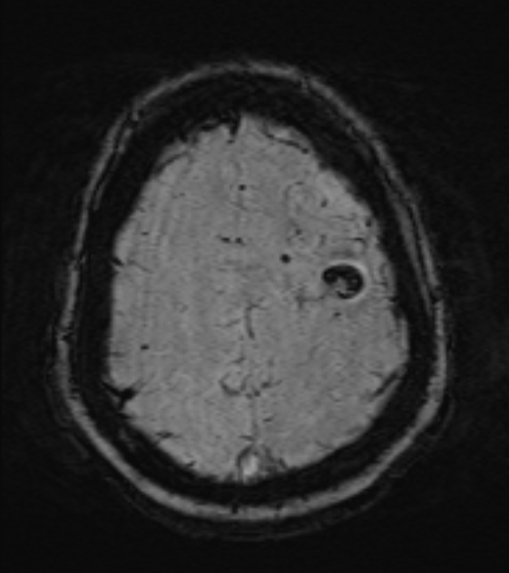 Cerebral venous infarct (Radiopaedia 53627-59685 Axial SWI 44).jpg