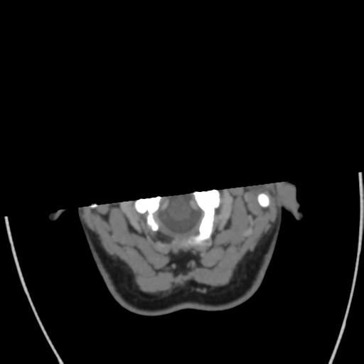 File:Cerebral venous infarct related to dural venous sinus thromboses (Radiopaedia 35292-36804 Axial C+ delayed 5).png